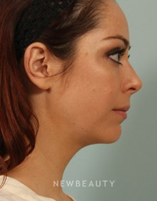 Dr. Kenneth Beer - Kybella - After