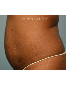 Dr. Ruth Hillelson - Thermage - Before