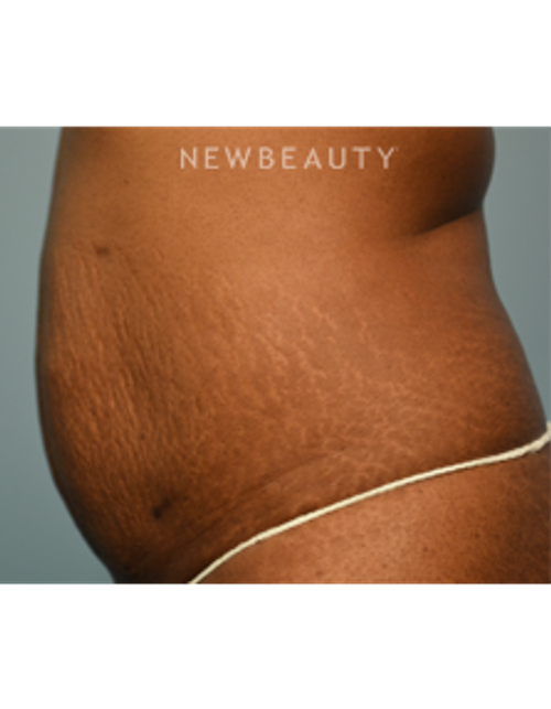 Dr. Ruth Hillelson - Thermage - Before