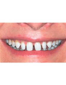Dr. Guy Lewis Veneers - Before