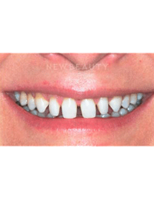 Dr. Guy Lewis Veneers - Before