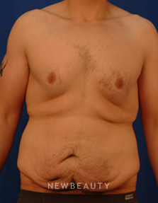 Dr. Peter Geldner Extended Abominoplasty with Side Resection - Before