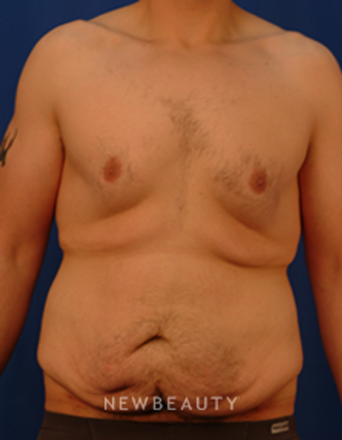 Dr. Peter Geldner Extended Abominoplasty with Side Resection - Before