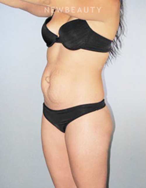 Dr. German Newall - Tighter Midsection - Before