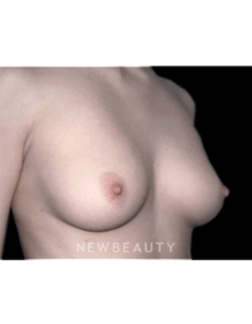 Dr. Michael Horn Breast Augmentation - Before