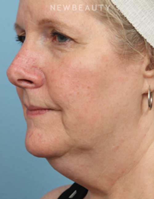 Dr. Kathleen Behr - CoolSculpting - Before