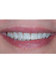 Dr. Guy Lewis Veneers - Before
