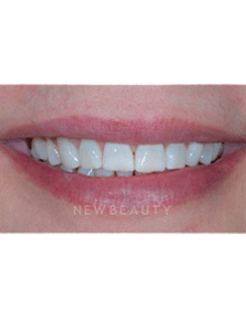 Dr. Guy Lewis Veneers - Before