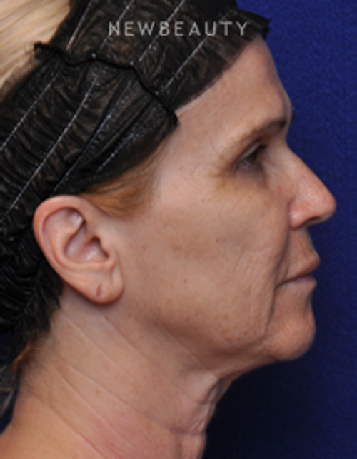 Dr. Alan J. Durkin - Facelift - Before