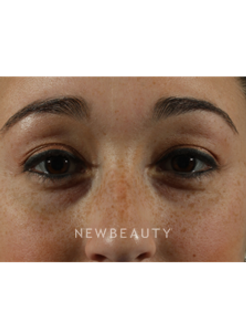 Dr. Marina Peredo - Restylane - Before