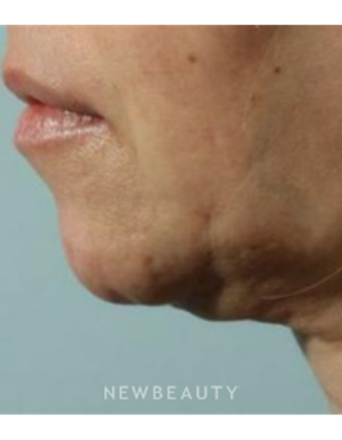 Dr. Marina Peredo - Necklift - Before
