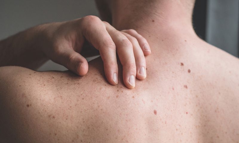 Close-up of a person’s bare upper back with visible moles and freckles, a hand resting on the shoulder