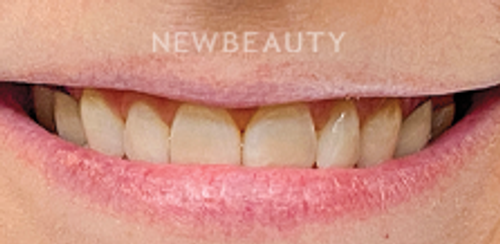 Dr. Sonya L. Wintzell - Vibrant Smile Design - 33124538 - Before