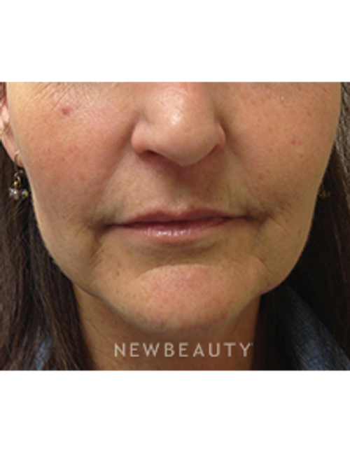 Dr. Kally Papantoniou - Liquid Facelift - Before
