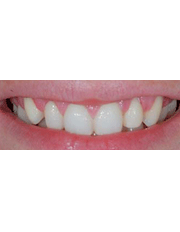 Dr. Guy Lewis Veneers - Before