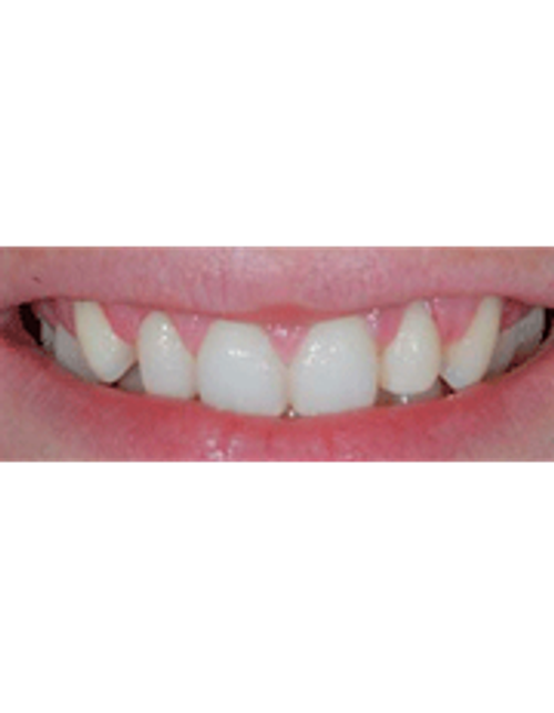Dr. Guy Lewis Veneers - Before