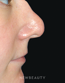 Dr. Lee Ann M. Klausner - Revision Rhinoplasty - Before
