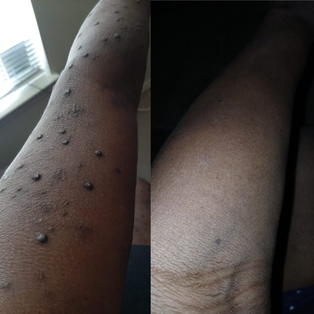 before and after itchy nodules on skin