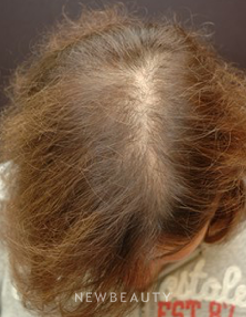 Dr. Jeffrey B. Wise - Hair Transplant - Before