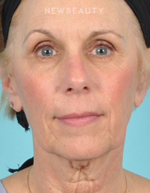 Dr. Bradley Bengtson - Facelift - Before
