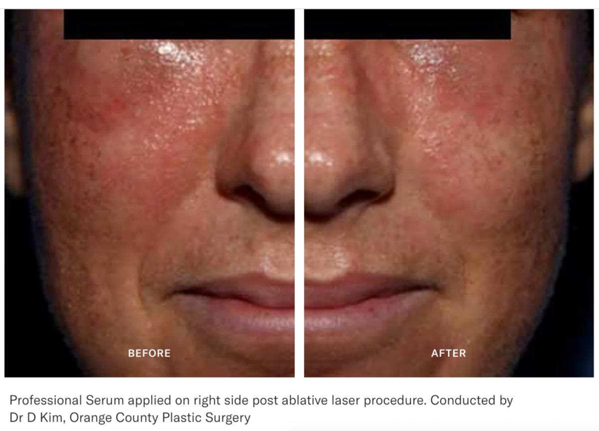 calecim professional serum before and after picture
