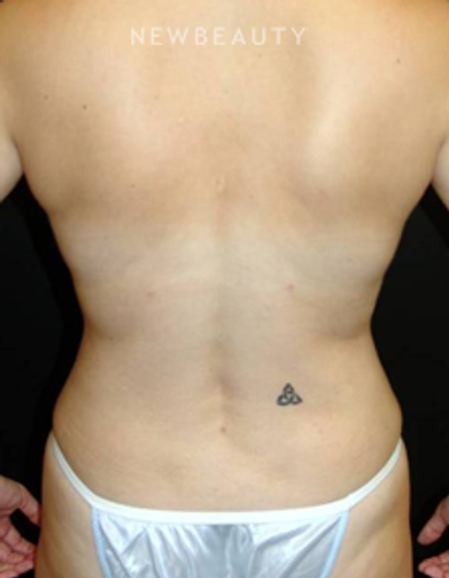 Dr. Mokhtar Asaadi - VASER Liposuction - After