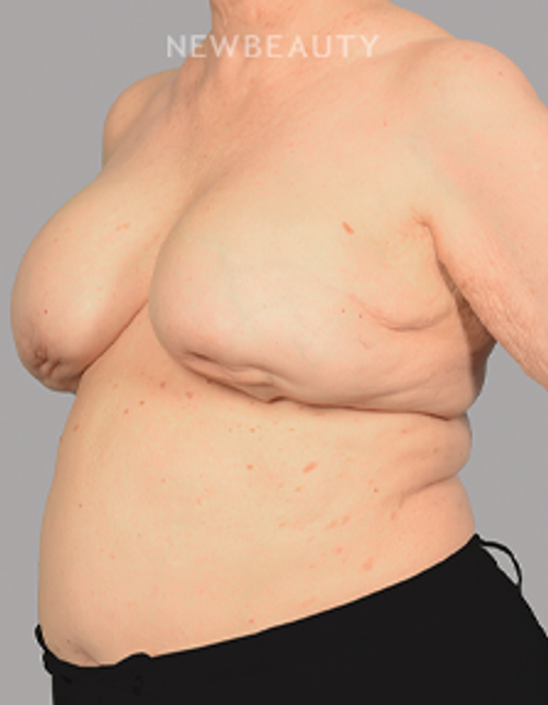 Dr. Mahabir - Breast Reconstruction - 20637718 - Before