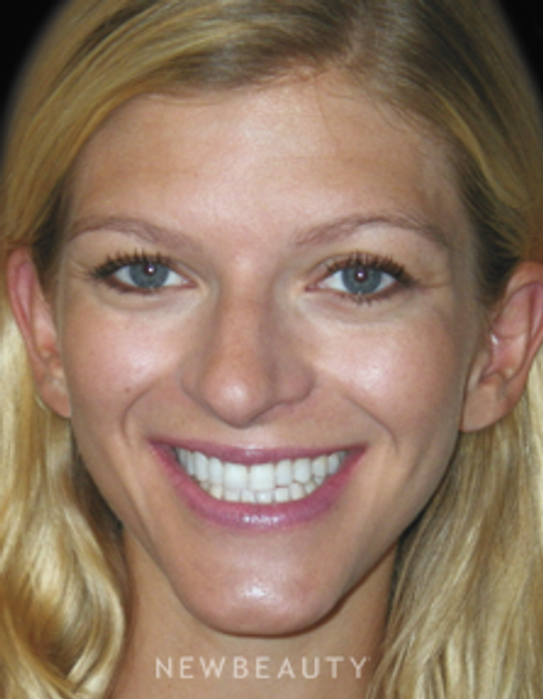 Dr. Irene Grafman - Smile Makeover - After