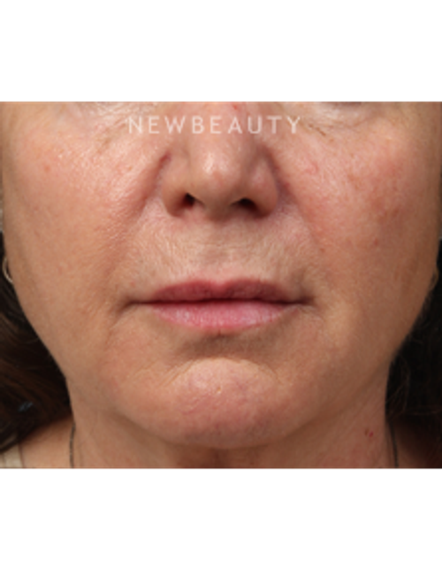 Dr. Kathleen Behr - Injectables & Fillers - After