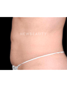 Dr. Ruth Hillelson Thermage - After