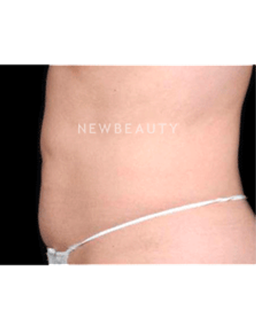 Dr. Ruth Hillelson Thermage - After