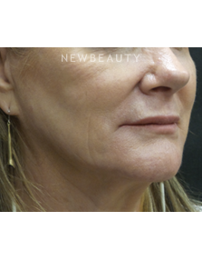 Dr. Jody Levine - Injectables and Fillers - After