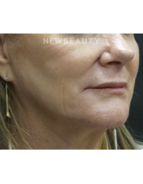Dr. Jody Levine - Injectables and Fillers - After