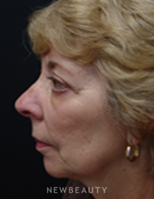 Dr. Mokhtar Asaadi Eyelid Lift - After