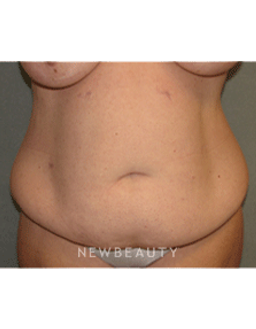 Dr Sean Simon Tummy Tuck, Lipo - Before