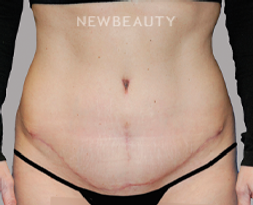 Dr. Carmen Kavali - Restoring Volume - 45241488 - After