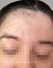 Dr. Anna Chacon - Seborrheic dermatitis - 34280035 - Before