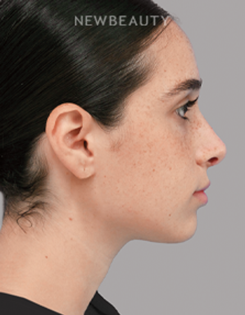 Dr. Michael A. Epstein - Natural-Looking Results - 33109401 - After