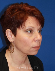 Dr. Dilip Madnani - Ultherapy - After