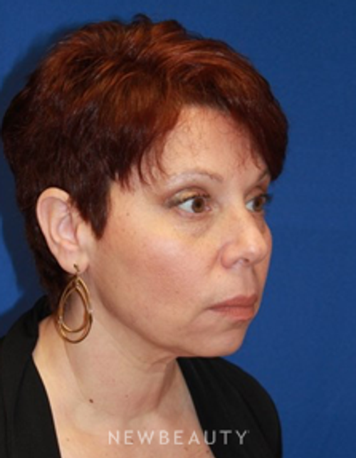 Dr. Dilip Madnani - Ultherapy - After