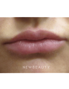 Dr. Jody Levine - Lip Filler - After