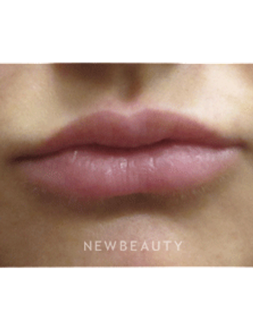 Dr. Jody Levine - Lip Filler - After