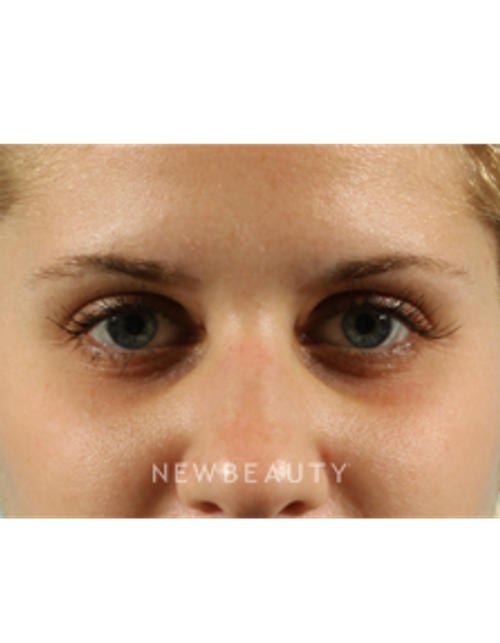 Dr. Marina Peredo - Latisse - Before