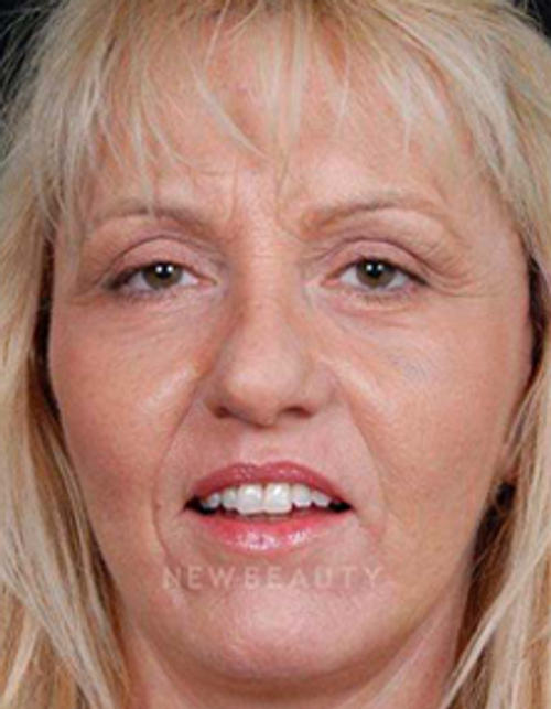 Dr. Steven Bloch Eyelid Lift, Face Lift, Fat Transfer - After