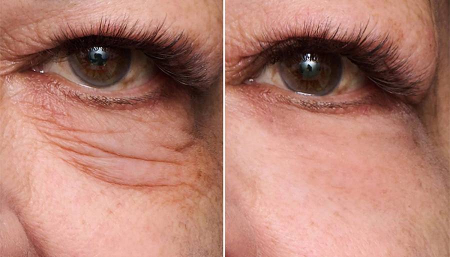 Peter Thomas Roth Instant FirmX Eye Easy Wear Eye Tightener before and after