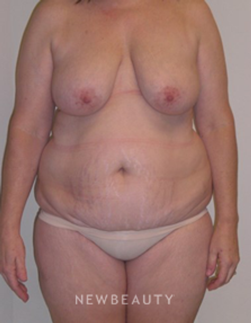 Dr. Carmen Kavali - Body - Before