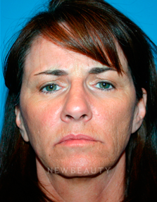 Dr. Kelly Bomer Liquid Facelift - Before