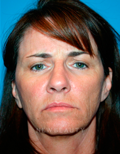 Dr. Kelly Bomer Liquid Facelift - Before