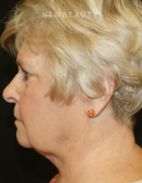 Dr. Joel Schlessinger - Reducing Excess Chin Fat - After