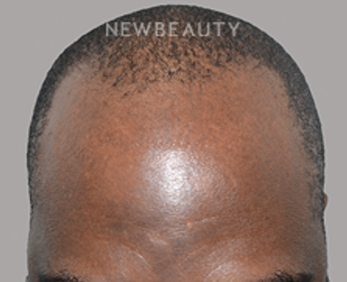 Dr. Jeffrey Epstein - Hair Transplant - 46167771 - Before